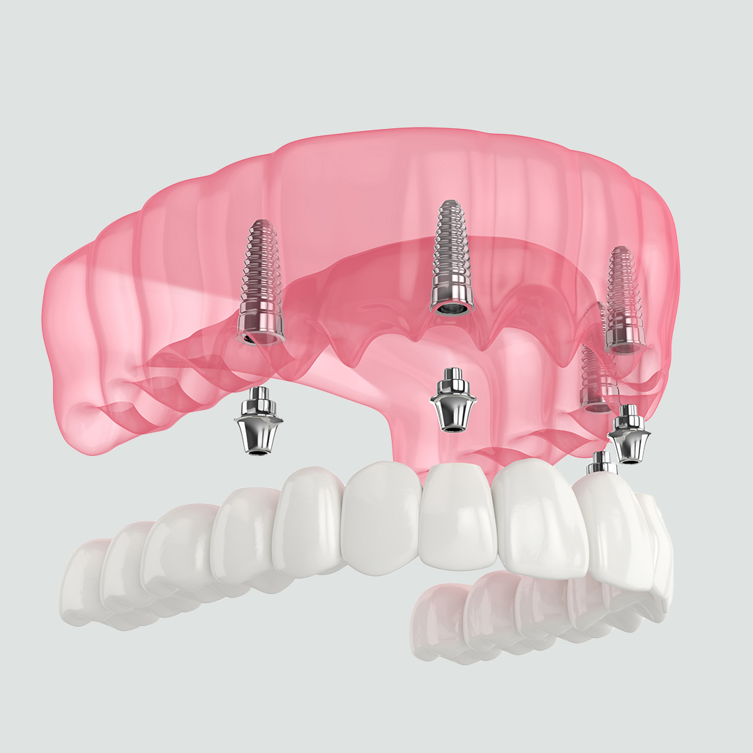 https://dentaressmile.nl/wp-content/uploads/2023/01/All-on-4-implants.jpg